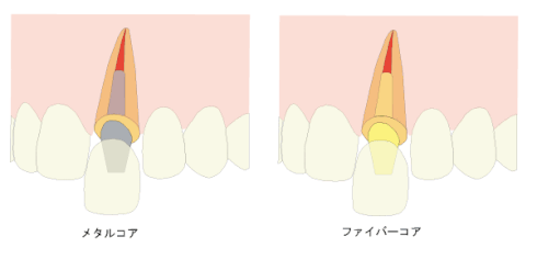 コアの審美性