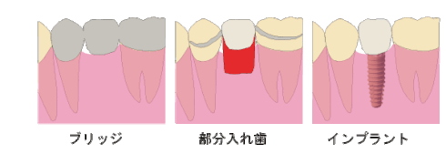 ブリッジ　部分入れ歯　インプラント