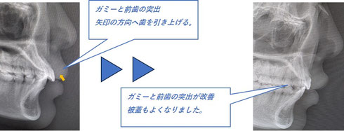 ガミーと出っ歯を治したいと訴える女性の矯正治療前後の比較。歯を抜かないで矯正治療。唇と前歯の関係が適切に並んでいます