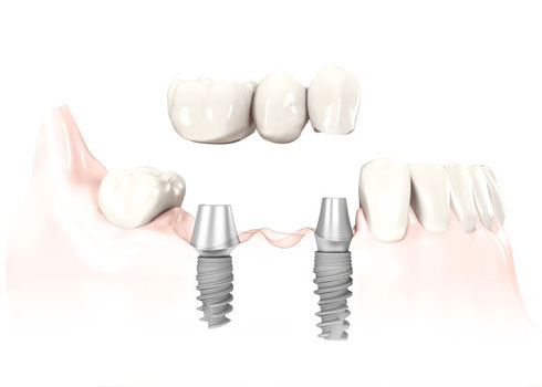 Brücke auf zwei Implantaten, geklebt