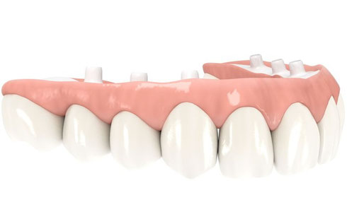 Brücke auf sechs Implantaten, Keramikgerüst mit ästhetischer Verblendung