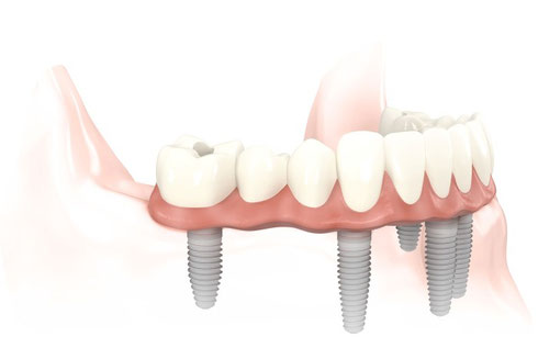 Brücke auf sechs Implantaten, verschraubt