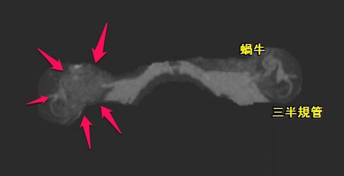 突発性難聴　MRI 