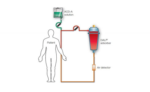 DALI 疗法 德国 血液净化 