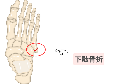 下駄骨折が起こる位置