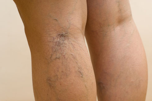 Varicose and spider vein treatment in Fayetteville, Georgia.