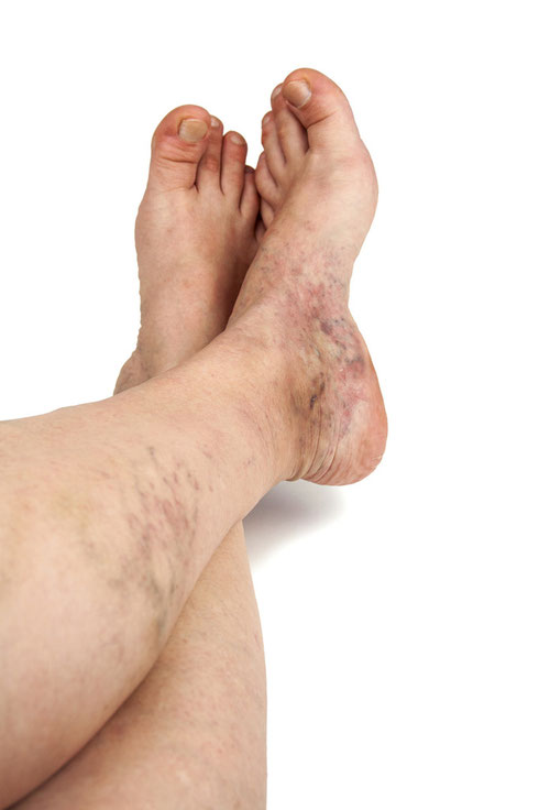 Signs of Vein Disease - Darkened Skin - Truffles Vein Specialists