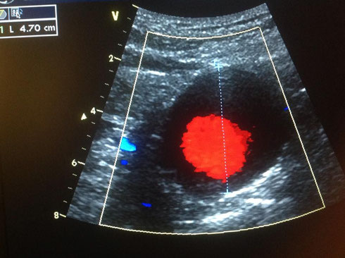 Abdominal Aortic Aneurysm Screening is a free service to those who have Medicare. Many people who qualify don't take advantage of this benefit.  Picture courtesy of Facebook's Vascular Technologist Page. 