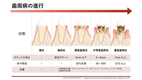 歯槽膿漏歯周病の進行と治療