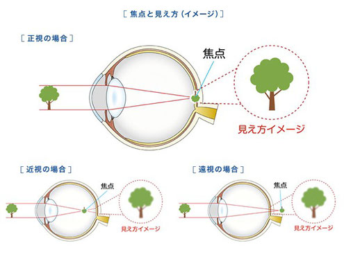 近視、遠視