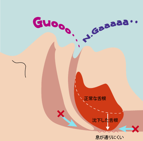 いびきが起こる解説イラスト　正常な舌根が上気道を圧迫している図。息が通りにくくなっていびきが起こります