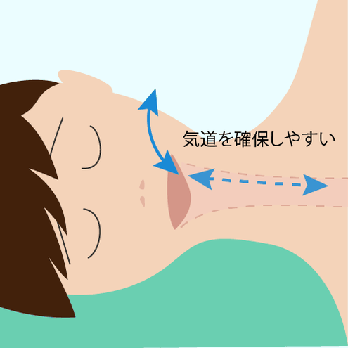 横向き寝にすると気道を確保しやすくなるという説明イラスト