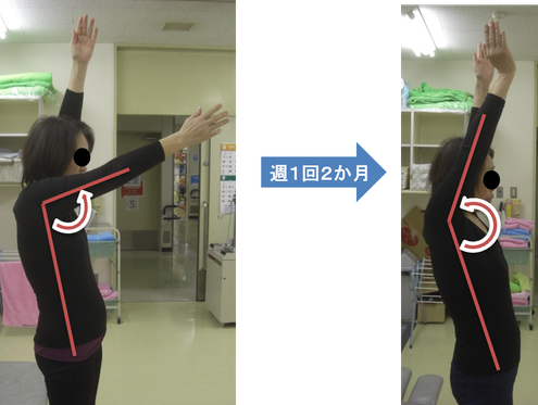肩の拘縮が改善　バンザイが出来るようになりました