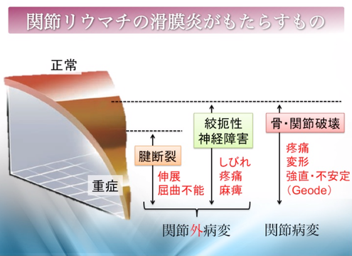 関節リウマチの滑膜炎がもたらすもの、國府幸洋、千葉県柏市、名戸ヶ谷病院