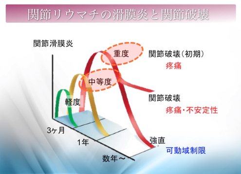 関節リウマチの滑膜炎と関節破壊、國府幸洋、千葉県柏市、名戸ヶ谷病院