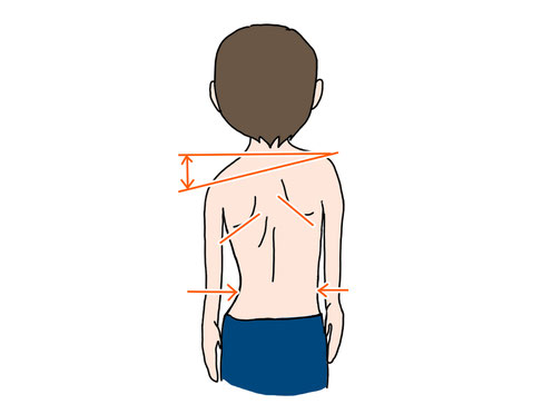 肩の高さが左右差のあるイラスト