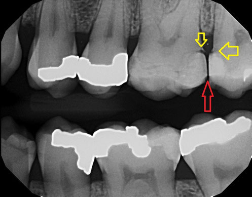 Food Stuck between teeth