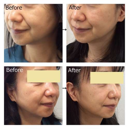 HIFU ハイフ 4D ウルトラ エステ 美容機器 ウルトラ4Dハイフ|andC Beauty salon