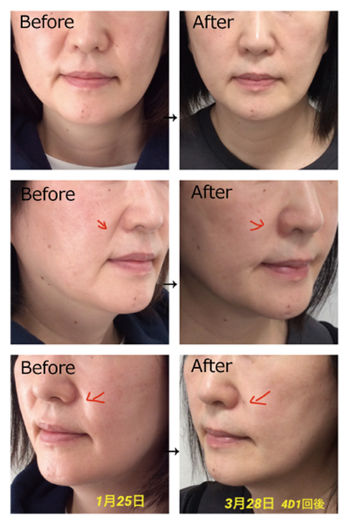 4D Ultra / ハイフ　HIFU 2 in 1 4D Hifu Vmax Hifu Ultrasound Wrinkle Removal Anti