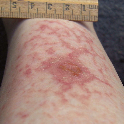 What Is This Rash On My Leg - Doctor answers on HealthTap