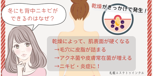 ニキビ 原因 背中