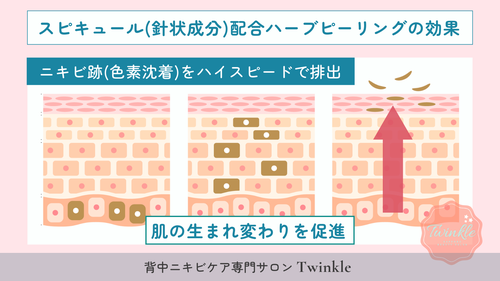 背中ニキビのニキビ跡改善のポイントは、肌のターンオーバーを促進するケアでニキビ跡をどんどん排出!