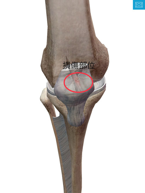 膝のケガ　前十字靭帯断裂