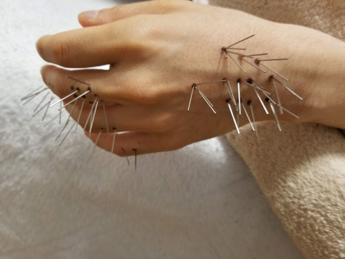 高麗手指鍼講座 高麗手指鍼講座 高麗手指鍼講座 : 日本語版(柳泰佑 原著 ; 樋田