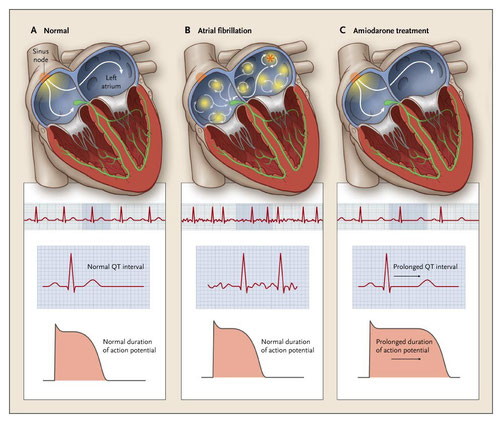 Fig.2: Action de l'amiodarone dans le traitement des tachycardies supraventriculaires (fibrillations auriculaires et flutter auriculaire)