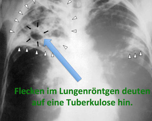 Tuberkulose