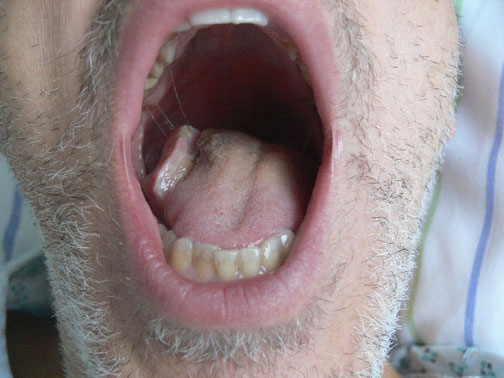 Mundaufnahme eines Patienten mit Zungengrundkarzinom vor der regionalen Chemotherapie, das einen Tumor im Mundraum zeigt.