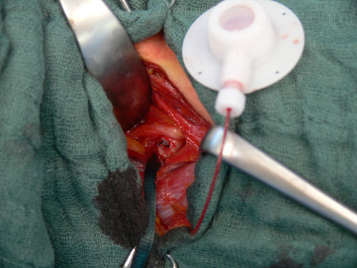 Chirurgischer Eingriff zur  End-zu-Seit Implantation des Port-Katheters in die A. subclavia bei einer Patientin mit Mammakarzinom.