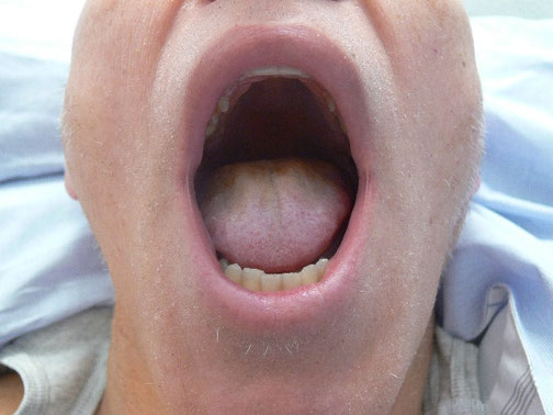 Mundaufnahme eines Patienten mit Zungengrundkarzinom nach der ersten regionalen Chemotherapie, zeigt eine erhebliche Tumorreduktion.