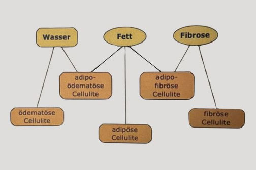Die drei Varianten und Stadien von Cellulite