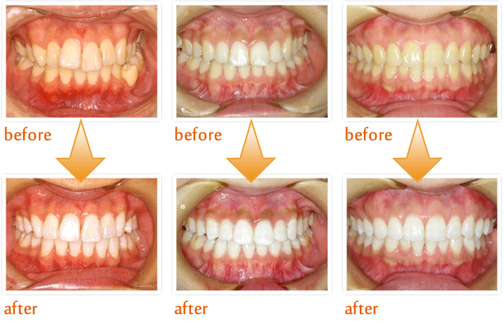 八戸市　ホワイトニング　おすすめ　安い