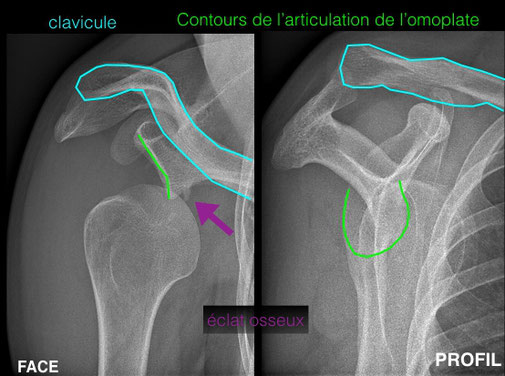 luxacion hombro Dr Julien Rémi cirugía deportiva ortopédica Toulouse St Jean Croix du Sud