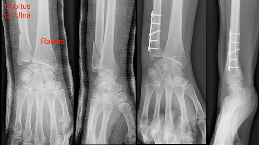 cirugia deportiva fractura muneca Dr Rémi Toulouse St Jean du Languedoc La Croix du Sud
