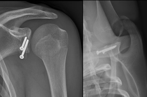 chirurgie orthopédique toulouse Dr Julien Rémi instabilité luxation d'épaule