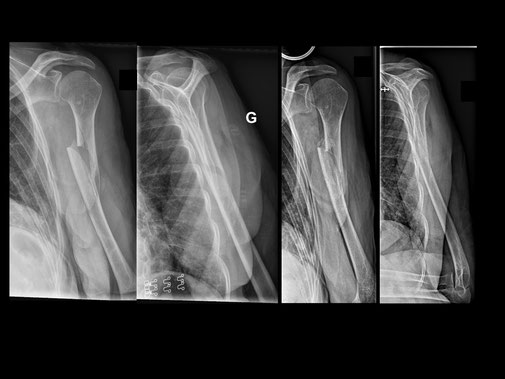 fracture humérus diaphysaire, traitement orthopédique, Dr Rémi, Toulouse, Croix du Sud