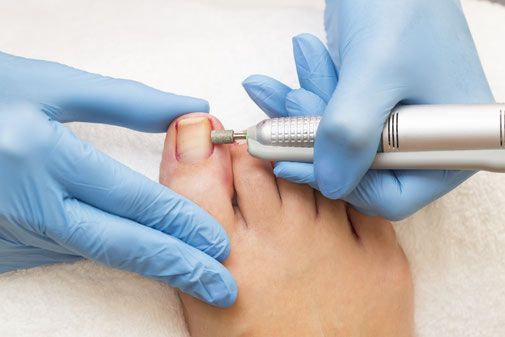 Pour éviter les infections dû à un ongle incarné, il est important de traiter très rapidement.