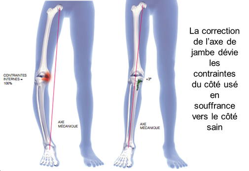 OTV ostéotomie tibiale de valgisation correction genu varum chirurgie Dr Rémi Toulouse