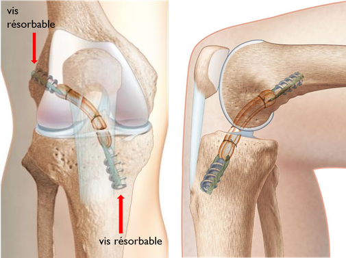 ligamentoplastie DT4 TLS ligament croisé antérieur résultat aspect final, chirurgie orthopédique dr Rémi Toulouse