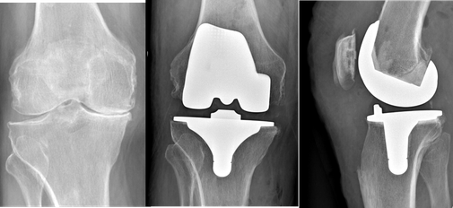 Absence de cartilage, symptômes douloureux diffus importants.                 Remplacement articulaire total : fémur tibia rotule