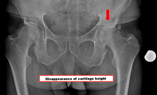 hip osteoarthritis total hip replacement Dr Rémi orthopaedic surgeon Toulouse France Capio Croix du Sud