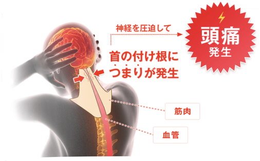 頭痛の原因