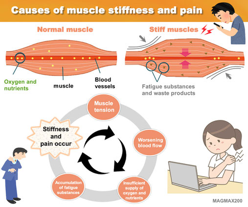 MAGMAX200/Causes of muscle stiffness and pain