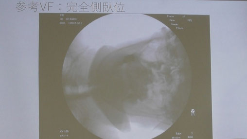 左下完全側臥位のVF動画を収録