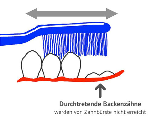 Beim normalen Zähneputzen werden die durchtretenden Zähne nicht erreicht (© Doc S)