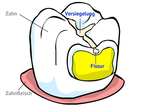 Fissuren-Versiegelung: Kariesschutz vom Zahnarzt für die Backenzähne (© wigerio)