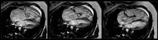 Coupe 4 cavités d'IRM montrant un vide de signal au niveau tricuspide avec dilatation de l'OD. Aspect typique d'une maladie d'Ebstein
